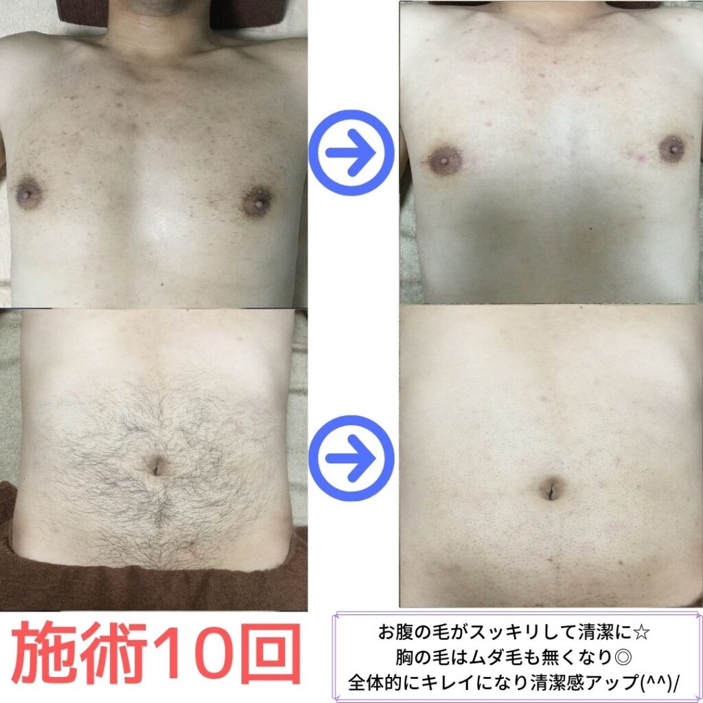 胸お腹脱毛効果